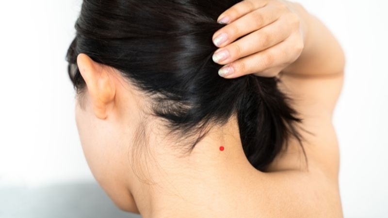 Nốt ruồi son sau gáy