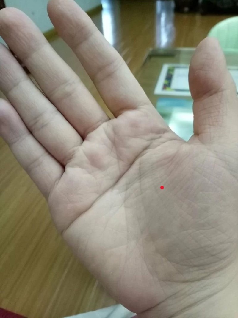 Nốt ruồi son trong lòng bàn tay phải nam