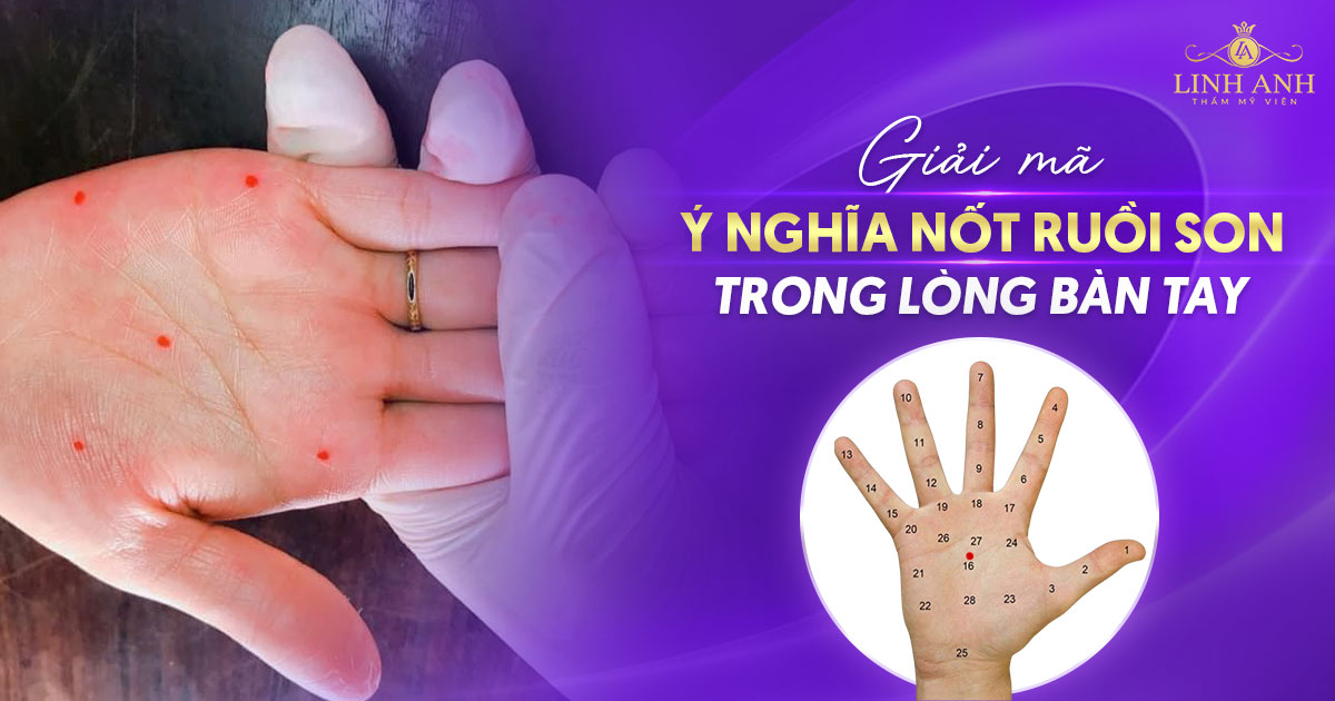 Nốt ruồi son trong lòng bàn tay