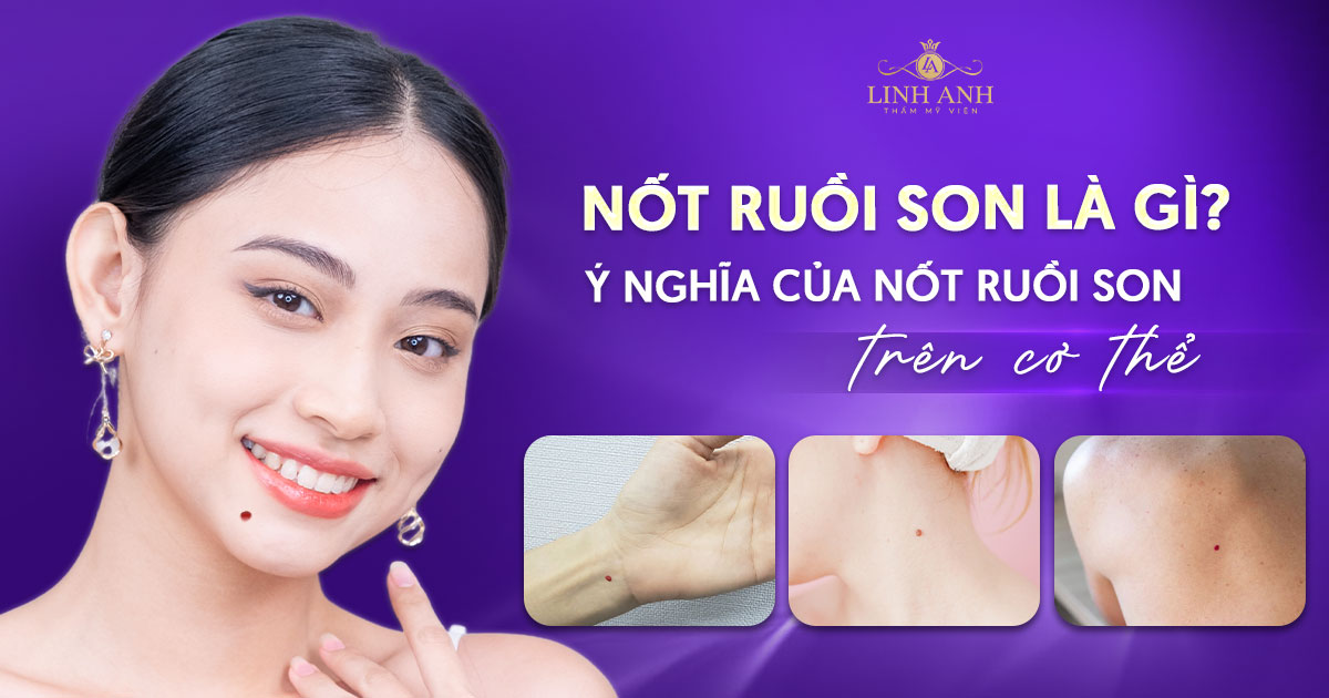 Nốt ruồi son là gì? Giải mã các nốt ruồi son trên cơ thể