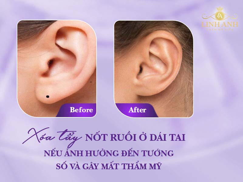 Nốt ruồi trên dái tai