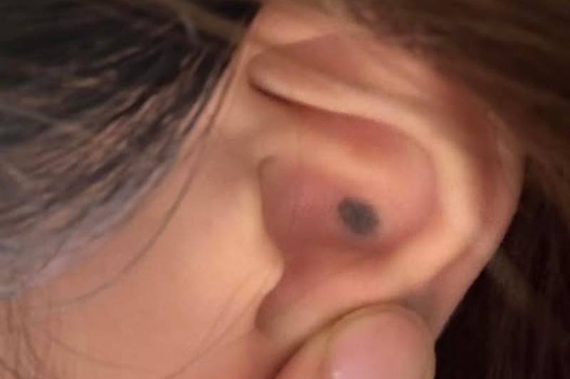 Nốt ruồi trong tai