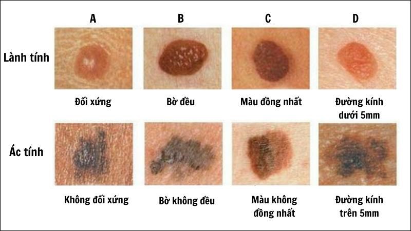 Nốt ruồi ung thư là gì