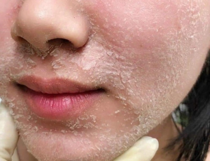 Da bị tăng sắc tố sau peel phải làm sao Peel da xong bị tăng sắc tố