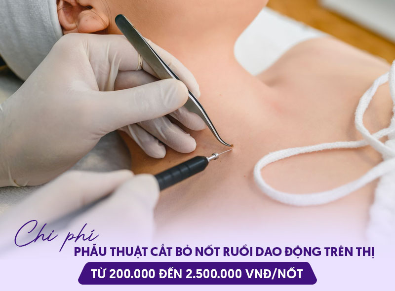 Phẫu thuật nốt ruồi bao nhiêu tiền