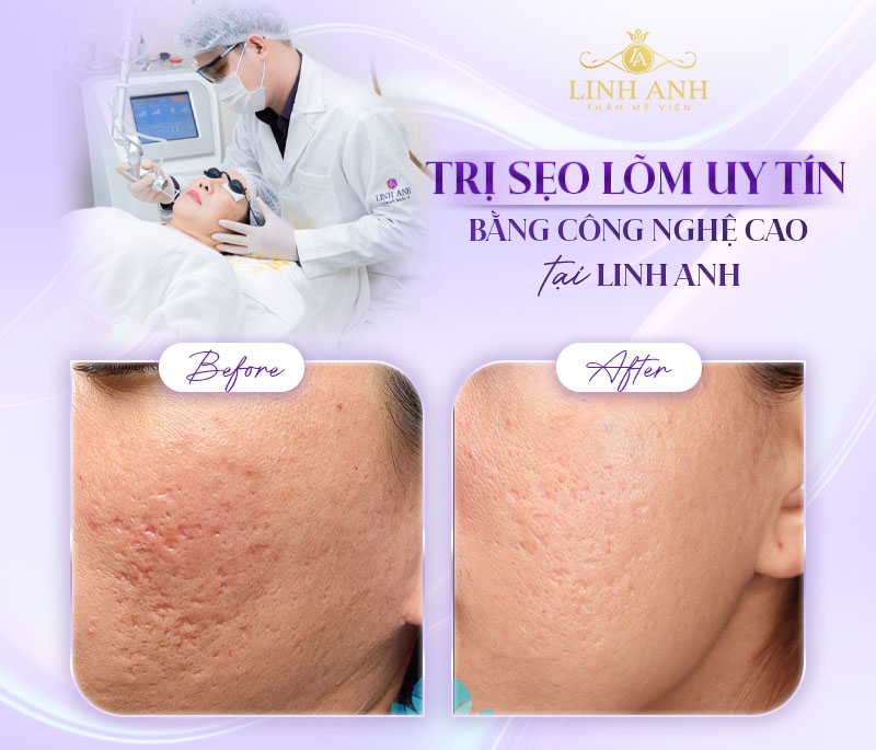 Phương pháp Trị sẹo lõm sau tẩy nốt ruồi