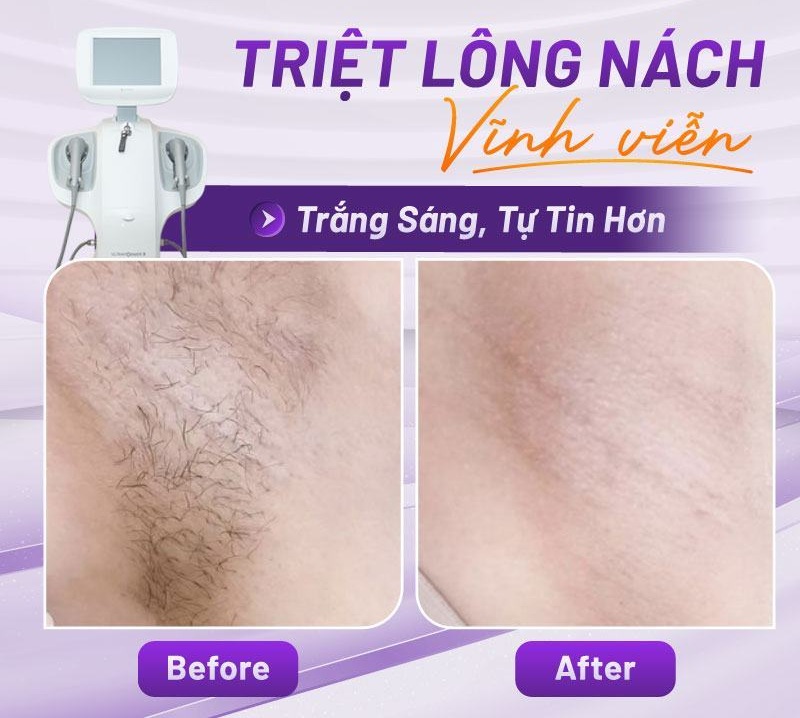 review triệt lông nách review triệt lông nách
