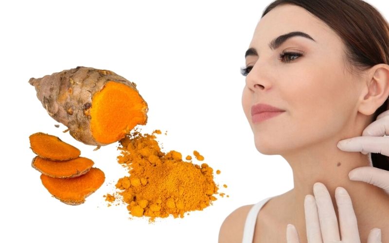 Sau khi tẩy nốt ruồi có nên bôi nghệ không