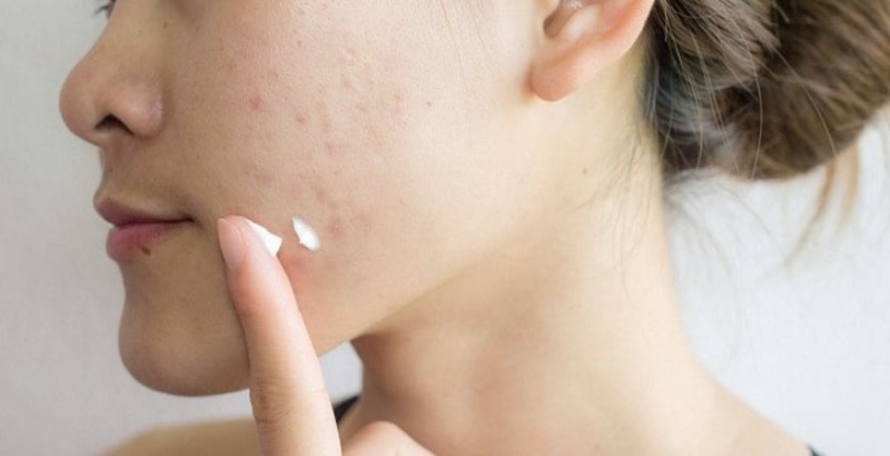 Sau khi tẩy nốt ruồi nên làm gì