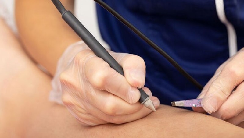 tác hại của triệt lông tác hại của triệt lông