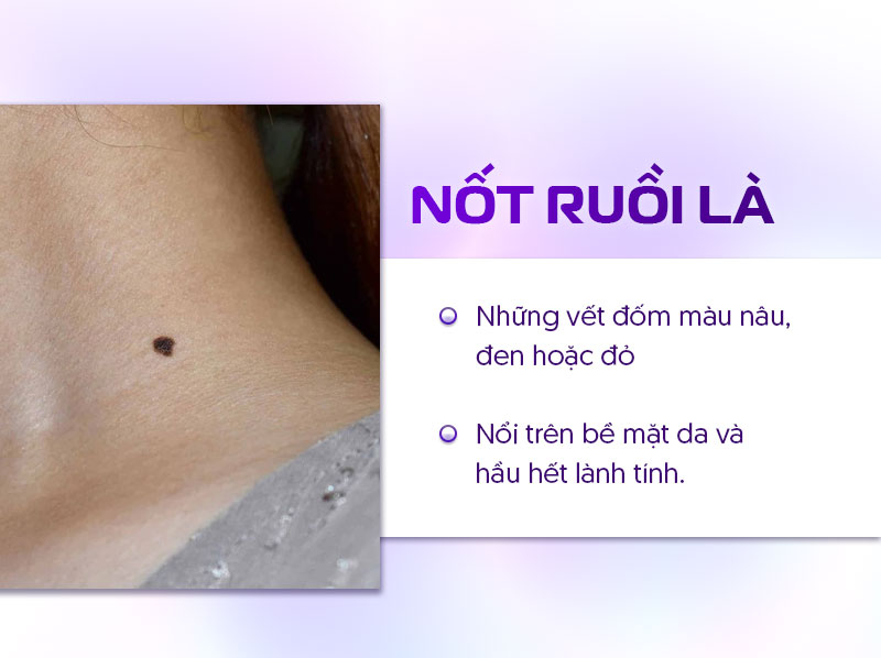 Tại sao lại có nốt ruồi Tại sao lại có nốt ruồi