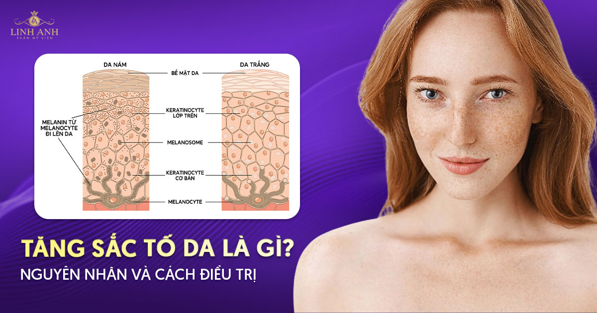 Tăng sắc tố da