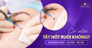 Tẩy nốt ruồi? Có nên tẩy nốt ruồi không