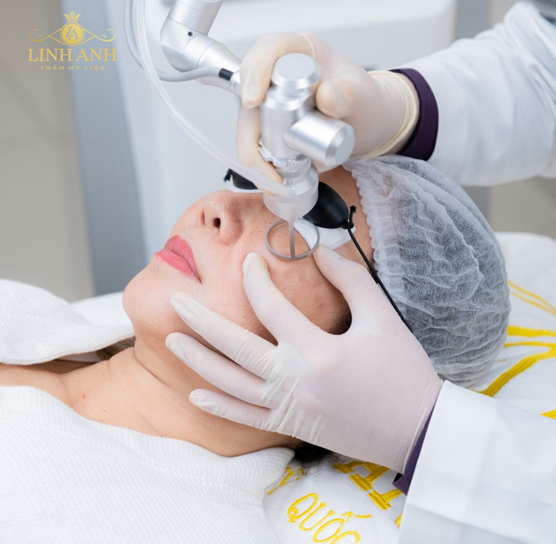 Tẩy nốt ruồi bằng laser bao lâu thì bong vảy