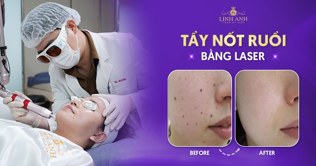 Tẩy nốt ruồi bằng laser