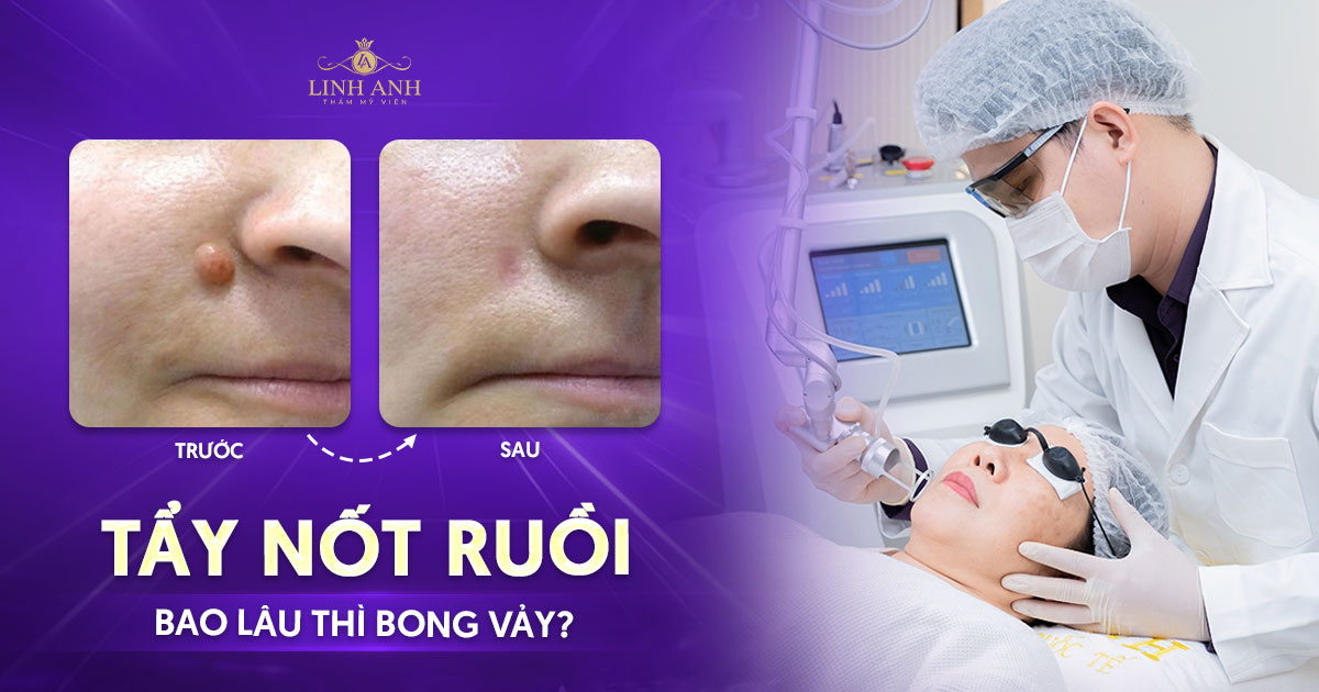 Tẩy nốt ruồi bao lâu thì bong vảy