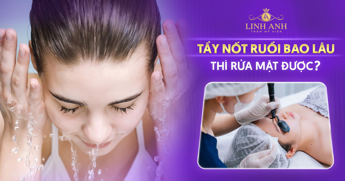 Tẩy nốt ruồi bao lâu thì rửa mặt