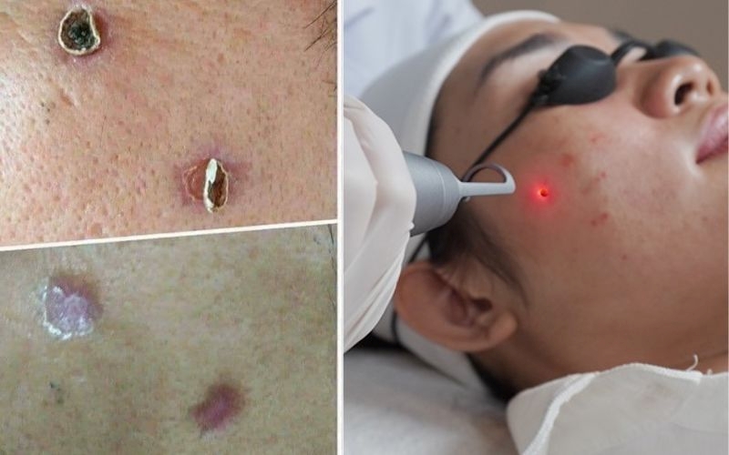 Tẩy nốt ruồi bao nhiêu ngày thì bong
