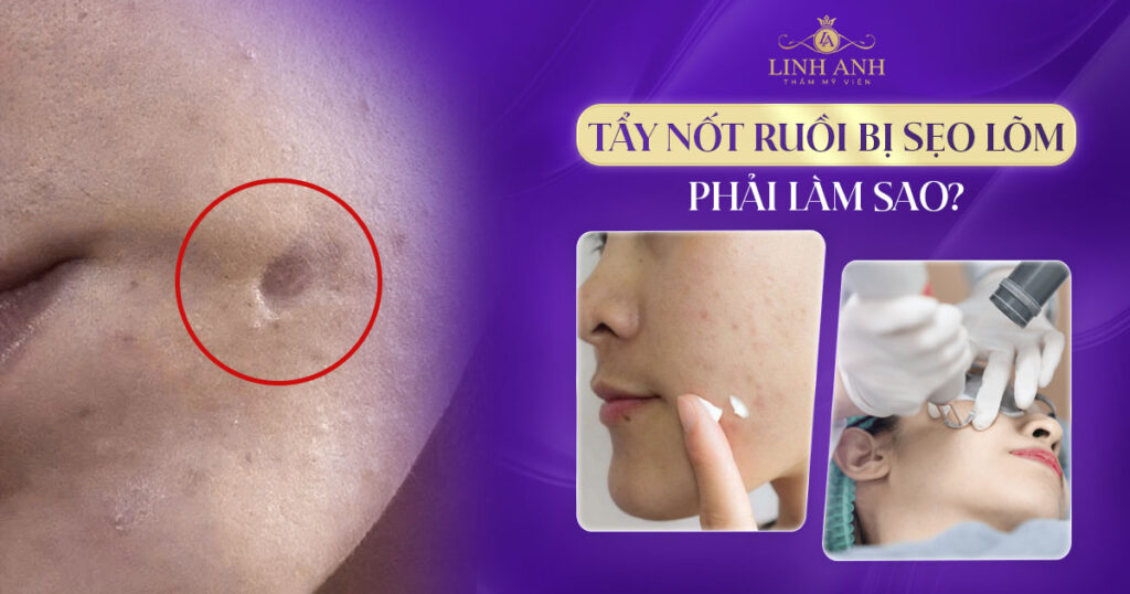 Tẩy nốt ruồi bị sẹo lõm phải làm sao