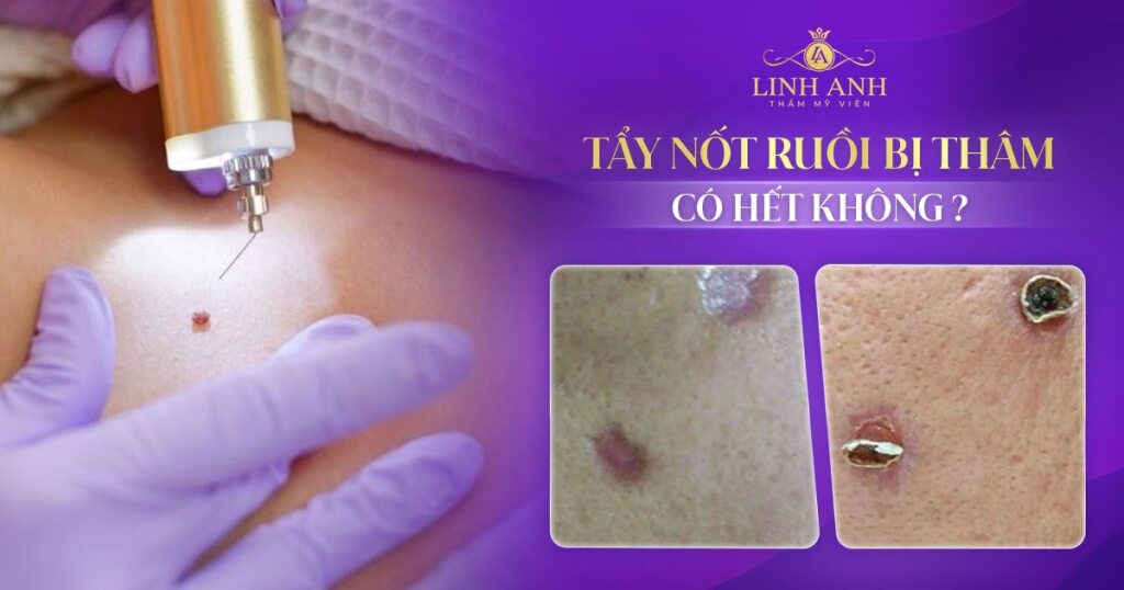 Tẩy nốt ruồi bị thâm có hết không