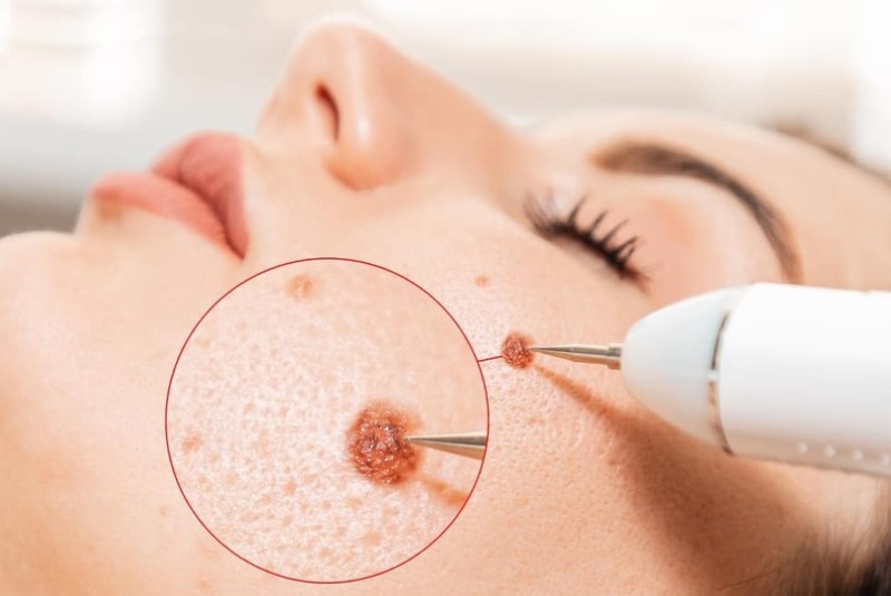 Tẩy nốt ruồi bị thâm có tự hết không