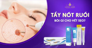 Tẩy nốt ruồi bôi gì cho hết sẹo