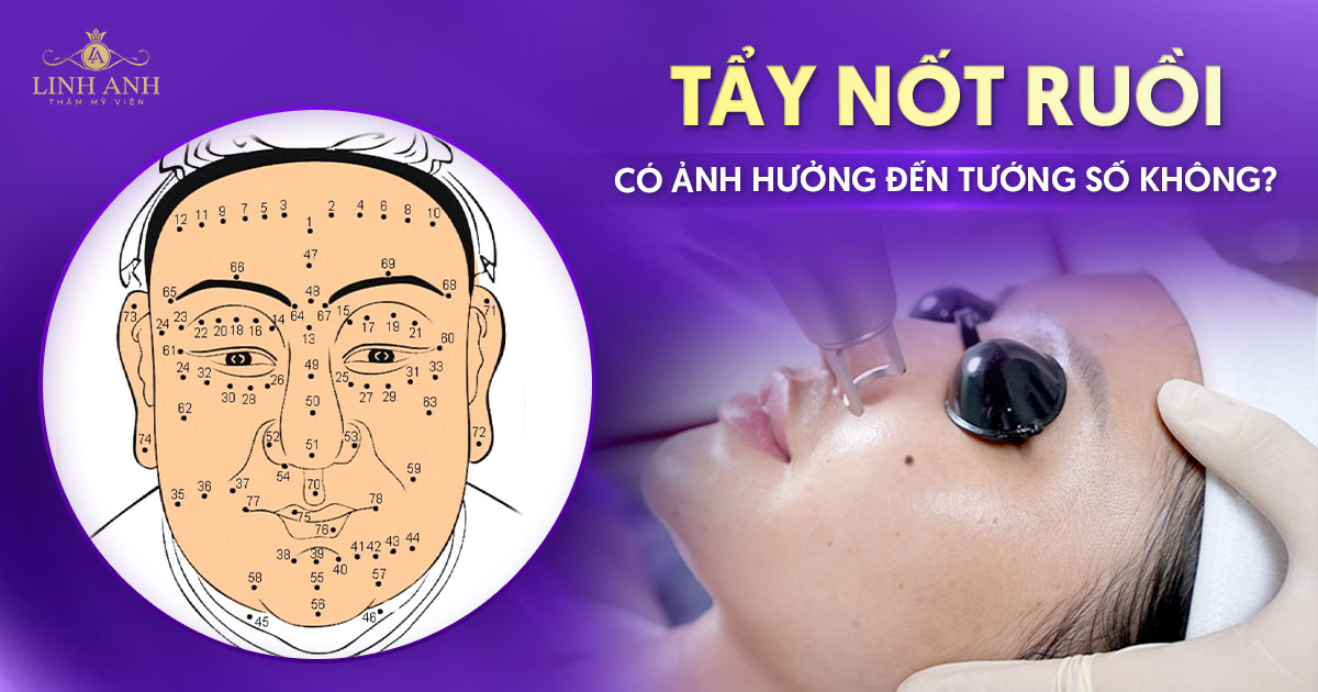 Tẩy nốt ruồi có ảnh hưởng đến tướng số không