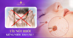 Tẩy nốt ruồi kiêng nước bao lâu