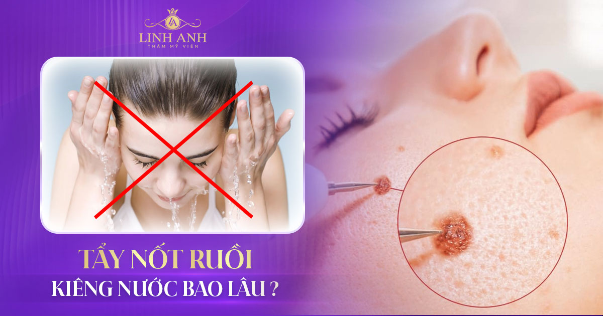 Tẩy nốt ruồi kiêng nước bao lâu
