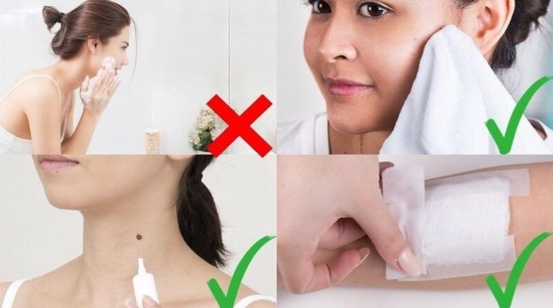 Tẩy nốt ruồi xong nên tránh làm gì