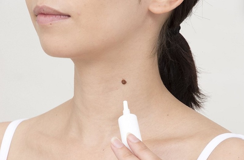 Tẩy nốt ruồi phải kiêng nước bao lâu