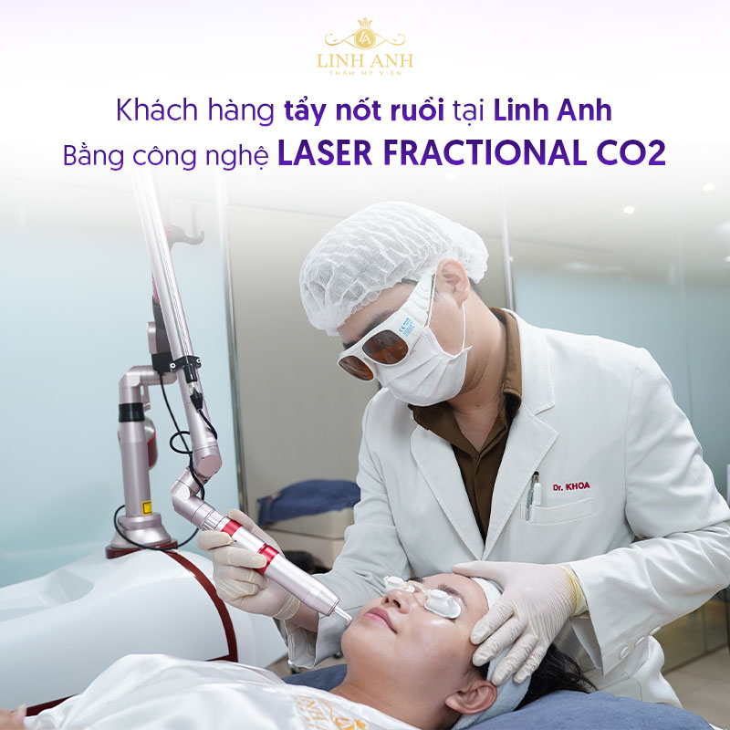 Tẩy nốt ruồi tại Linh Anh bằng công nghệ Laser Fractional CO2