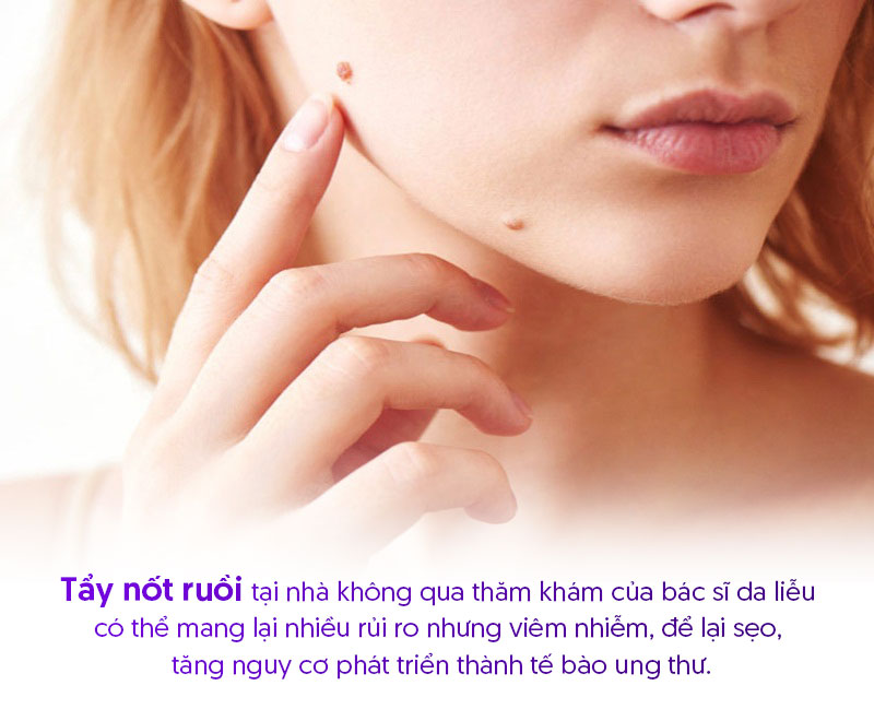 Tẩy nốt ruồi tại nhà có nên hay không