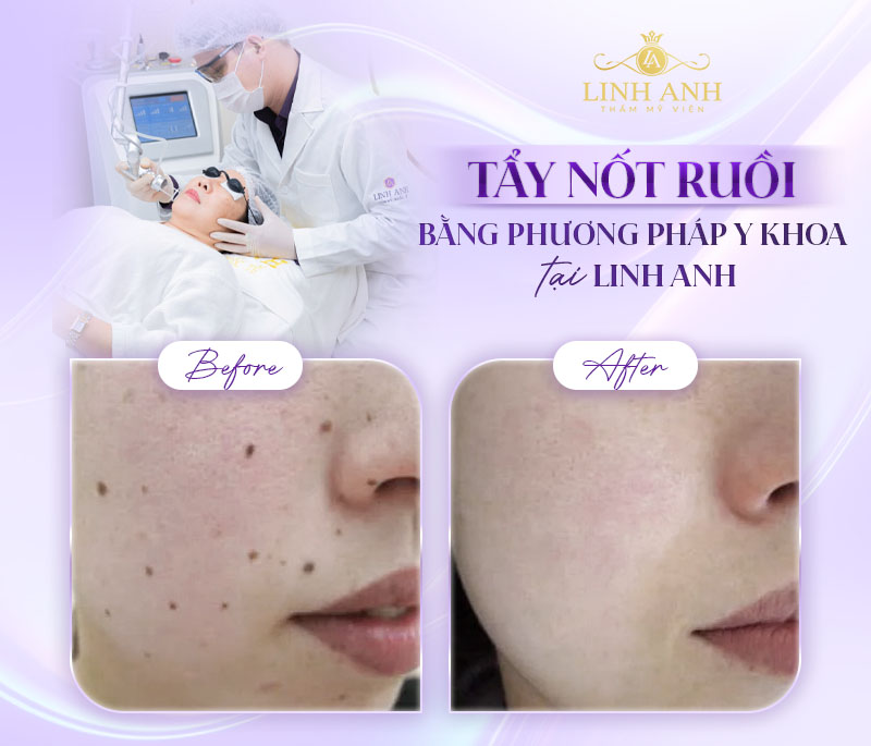 Tẩy nốt ruồi trong ngày nhanh an toàn