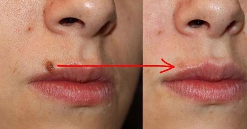 Tẩy nốt ruồi xong bị thâm