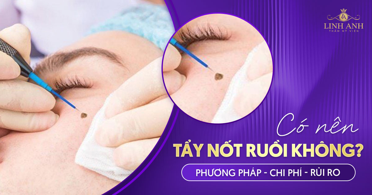 Tẩy nốt ruồi? Có nên tẩy nốt ruồi không