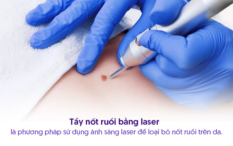 Tẩy Xóa nốt ruồi bằng tia laser Tẩy Xóa nốt ruồi bằng tia laser