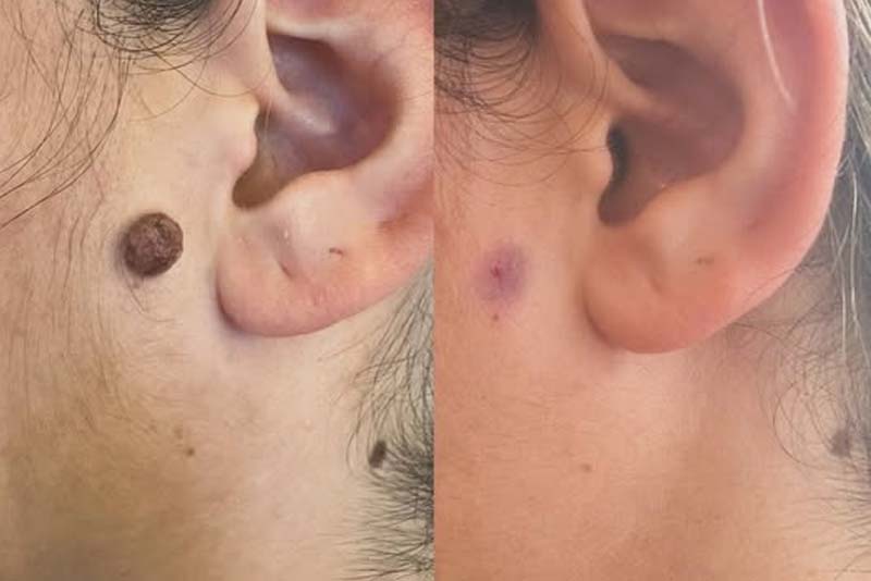 Thâm sau tẩy nốt ruồi có hết không