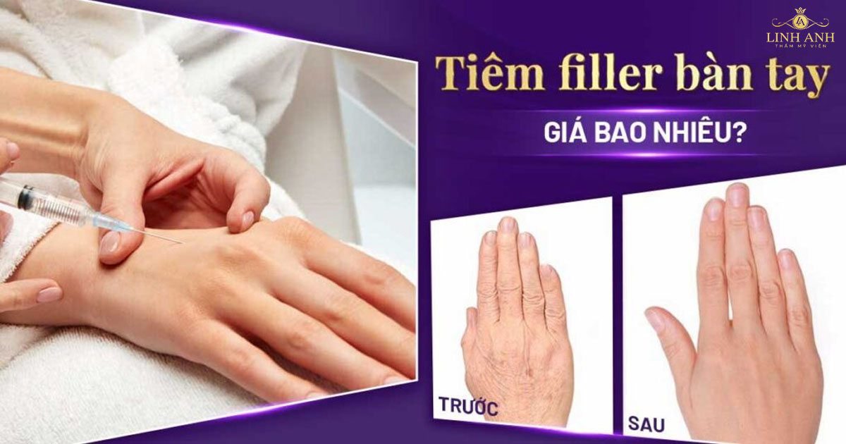 Tiêm filler bàn tay giá bao nhiêu? Các yếu tố ảnh hưởng