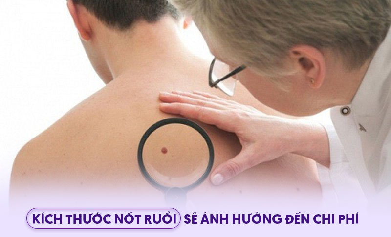 Tiểu phẫu nốt ruồi giá bao nhiêu