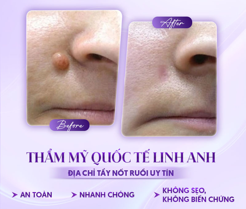 Tiểu phẫu nốt ruồi ở đâu uy tín