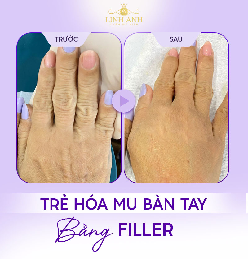 Trẻ hóa bàn tay bằng filler Trẻ hóa bàn tay bằng filler