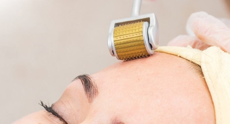 Trị sẹo lõm sau tẩy nốt ruồi