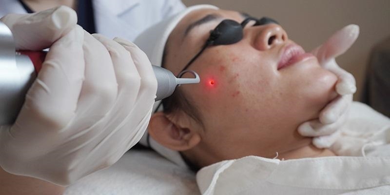 Trị sẹo thâm sau khi tẩy nốt ruồi
