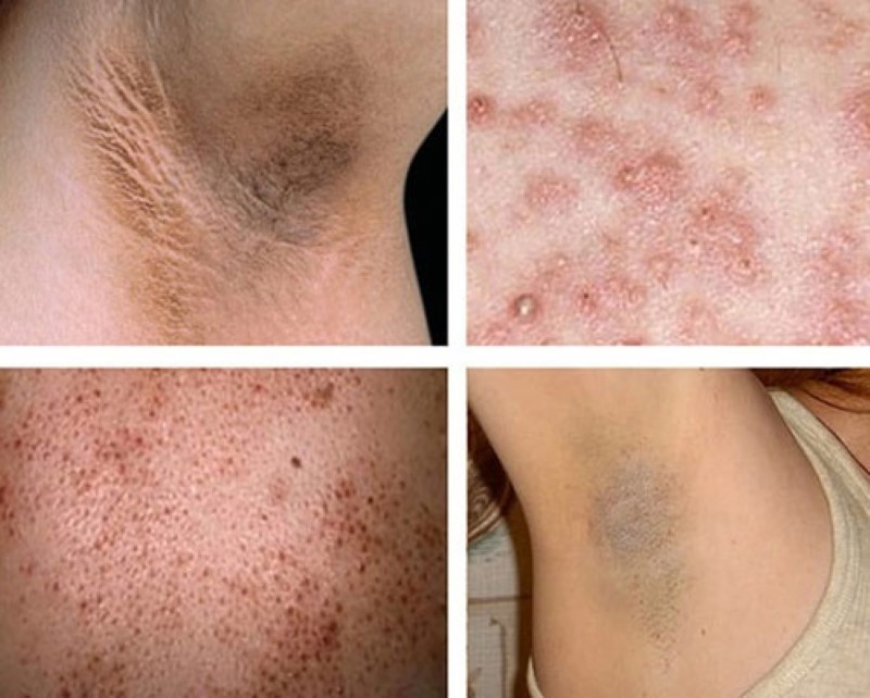 triệt lông có ảnh hưởng đến sức khỏe không triệt lông có ảnh hưởng đến sức khỏe không