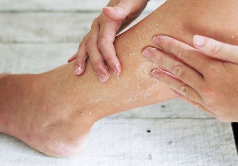 triệt lông khiến da bị bong tróc triệt lông khiến da bị bong tróc