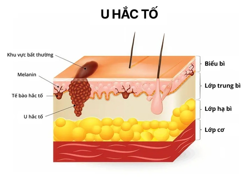 Ung thư hắc tố có chữa được không