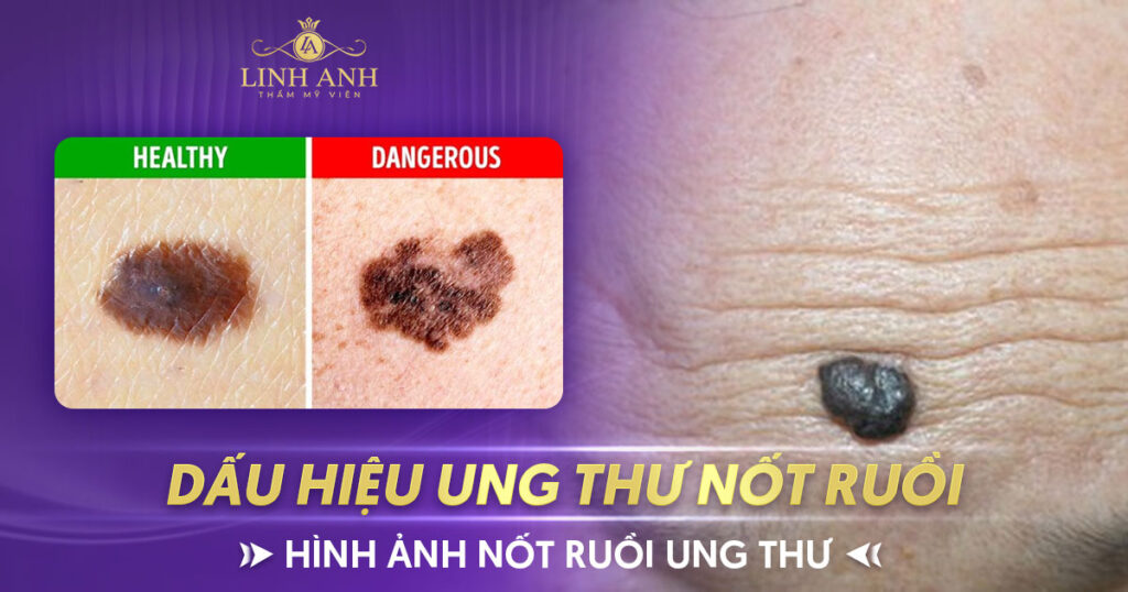 Ung thư nốt ruồi