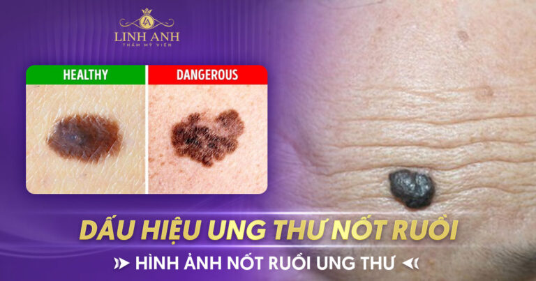 Dấu hiệu nhận biết ung thư nốt ruồi – Hình ảnh nốt ruồi ung thư