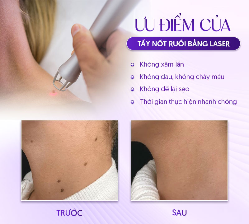 Ưu điểm tẩy nốt ruồi bằng laser CO2